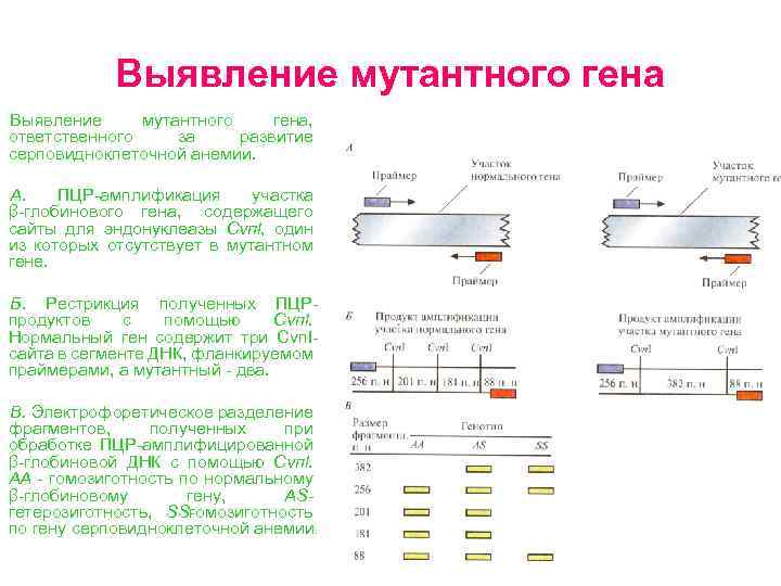 Выявление мутантного гена, ответственного за развитие серповидноклеточной анемии. А. ПЦР амплификация участка β глобинового