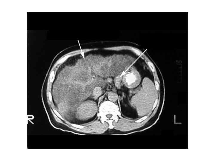 Неровный край Варикозно расширенные вены 