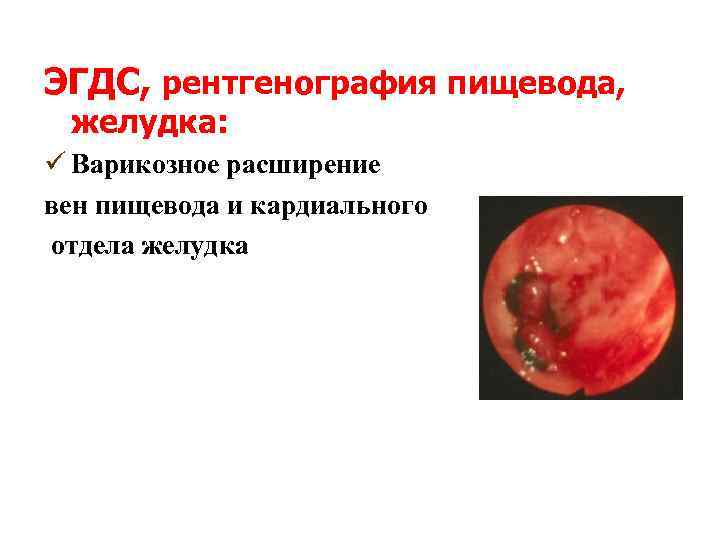 ЭГДС, рентгенография пищевода, желудка: ü Варикозное расширение вен пищевода и кардиального отдела желудка 