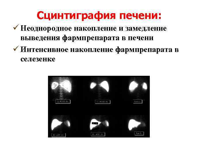 Сцинтиграфия печени: ü Неоднородное накопление и замедление выведения фармпрепарата в печени ü Интенсивное накопление
