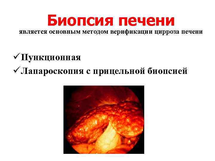 Биопсия печени является основным методом верификации цирроза печени ü Пункционная ü Лапароскопия с прицельной