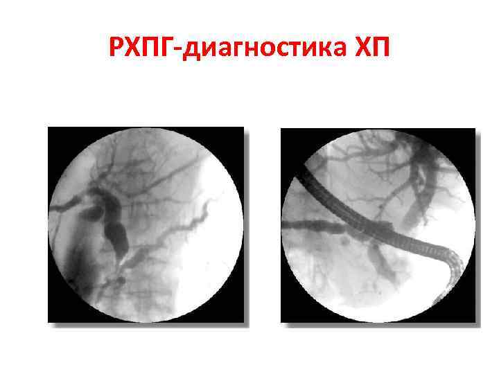 РХПГ-диагностика ХП 