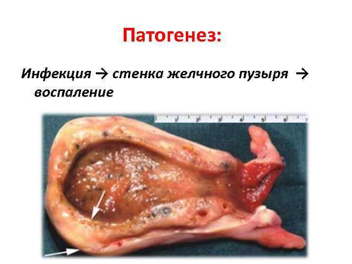 Патогенез: Инфекция → стенка желчного пузыря → воспаление 