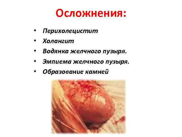 Осложнения: • • • Перихолецистит Холангит Водянка желчного пузыря. Эмпиема желчного пузыря. Образование камней.