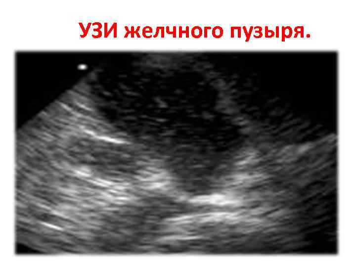 УЗИ желчного пузыря. 