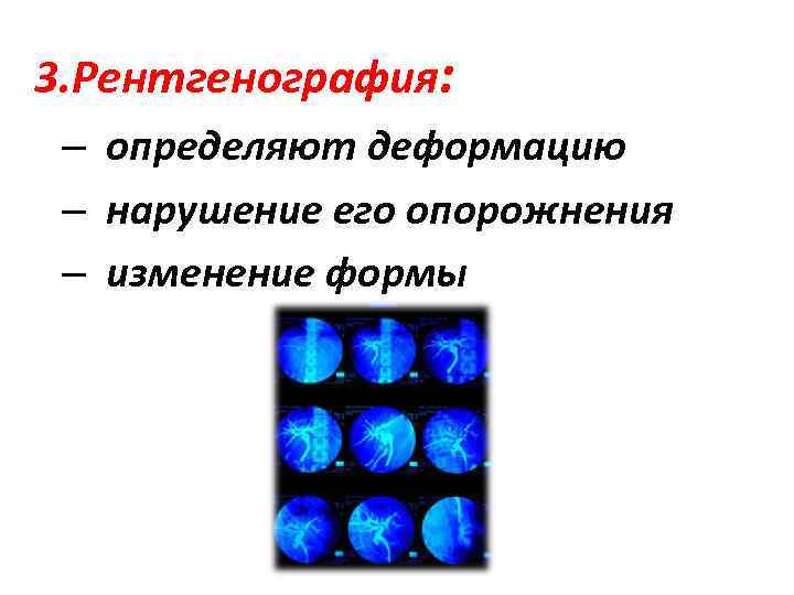 3. Рентгенография: – определяют деформацию – нарушение его опорожнения – изменение формы 