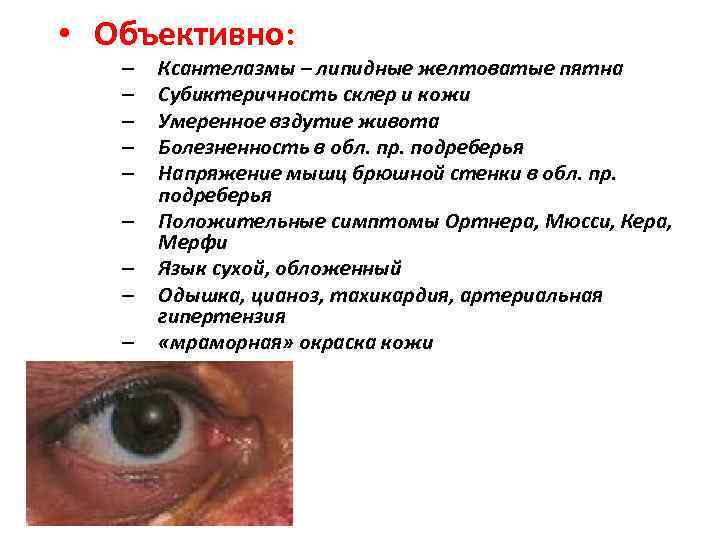  • Объективно: – – – – – Ксантелазмы – липидные желтоватые пятна Субиктеричность