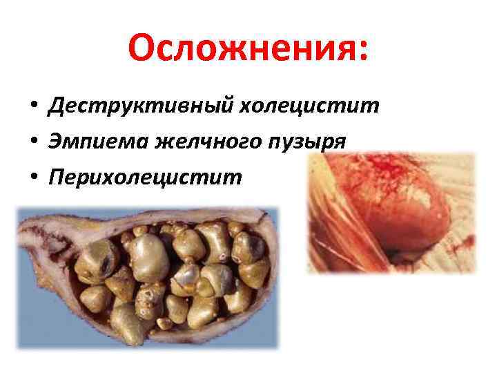 Осложнения: • Деструктивный холецистит • Эмпиема желчного пузыря • Перихолецистит 
