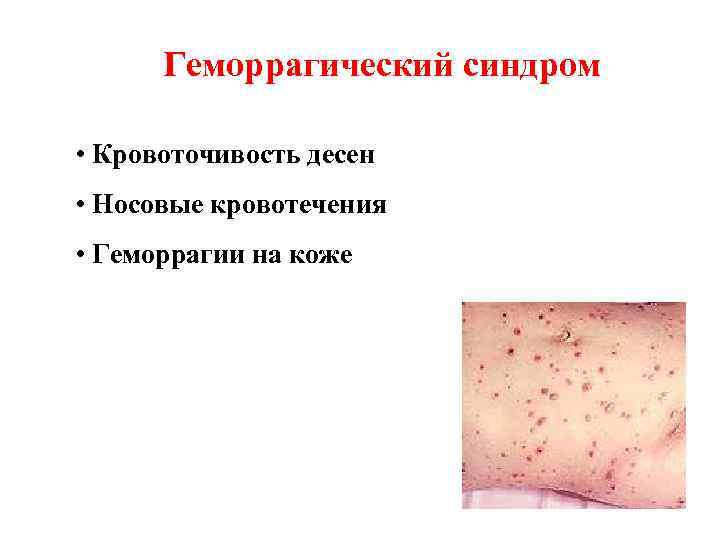 Геморрагический синдром • Кровоточивость десен • Носовые кровотечения • Геморрагии на коже 