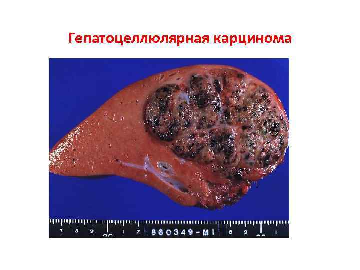 Гепатоцеллюлярная карцинома 
