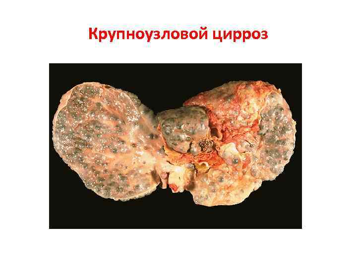 Крупноузловой цирроз 