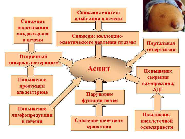 Снижение инактивации альдостерона в печени Вторичный гиперальдостеронизм Повышение продукции альдостерона Повышение лимфопродукции в печени
