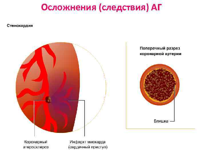 Осложнения (следствия) АГ 