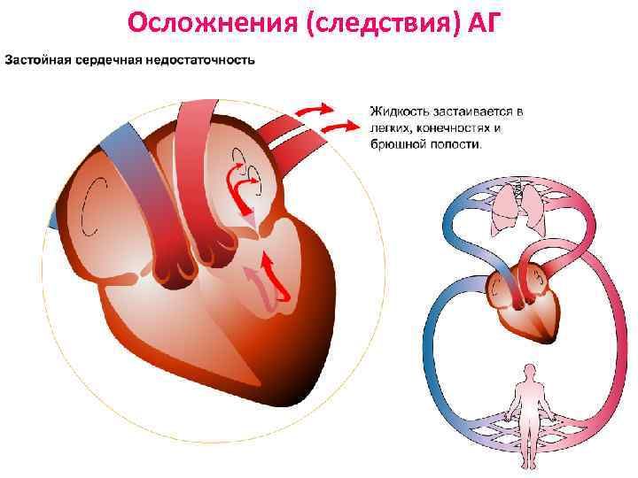 Осложнения (следствия) АГ 