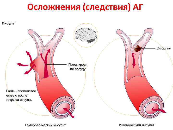 Осложнения (следствия) АГ 