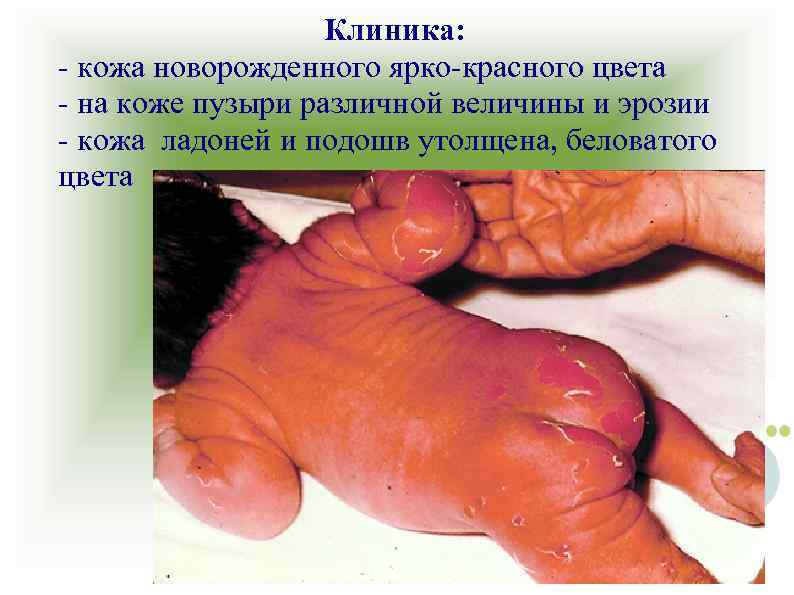 Клиника: - кожа новорожденного ярко-красного цвета - на коже пузыри различной величины и эрозии