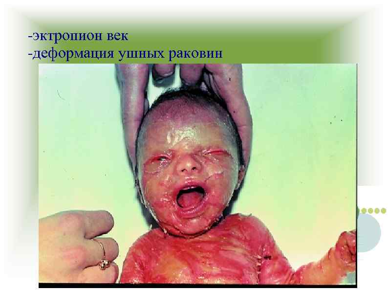 -эктропион век -деформация ушных раковин 