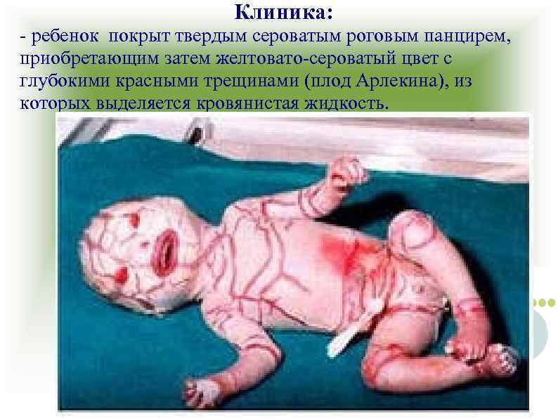 Клиника: - ребенок покрыт твердым сероватым роговым панцирем, приобретающим затем желтовато-сероватый цвет с глубокими
