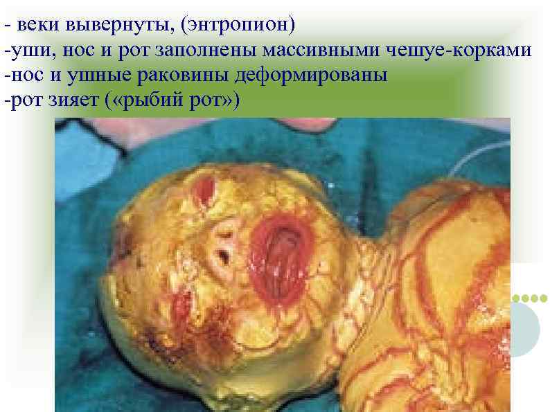 - веки вывернуты, (энтропион) -уши, нос и рот заполнены массивными чешуе-корками -нос и ушные