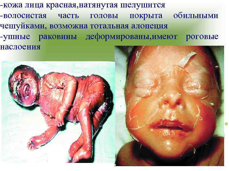 -кожа лица красная, натянутая шелушится -волосистая часть головы покрыта обильными чешуйками, возможна тотальная алопеция