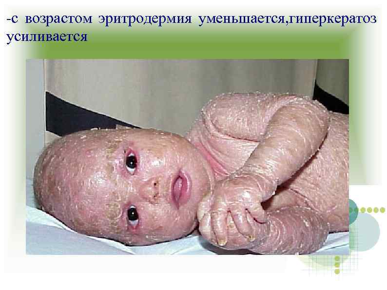 -с возрастом эритродермия уменьшается, гиперкератоз усиливается 