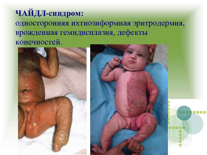 ЧАЙДЛ-синдром: односторонняя ихтиозиформная эритродермия, врожденная гемидисплазия, дефекты конечностей. 