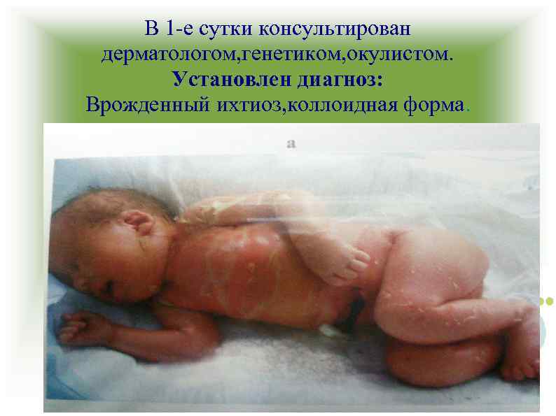В 1 -е сутки консультирован дерматологом, генетиком, окулистом. Установлен диагноз: Врожденный ихтиоз, коллоидная форма.