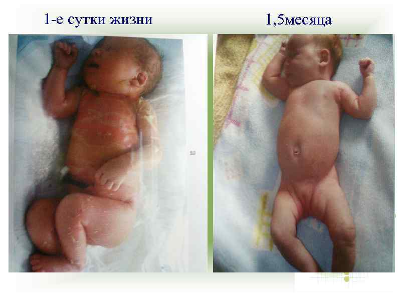 1 -е сутки жизни 1, 5 месяца 