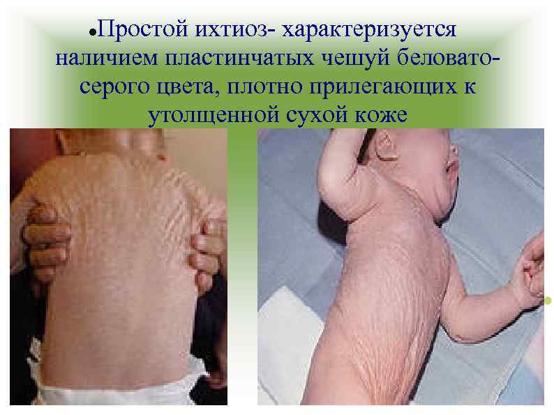 Простой ихтиоз- характеризуется наличием пластинчатых чешуй беловатосерого цвета, плотно прилегающих к утолщенной сухой коже