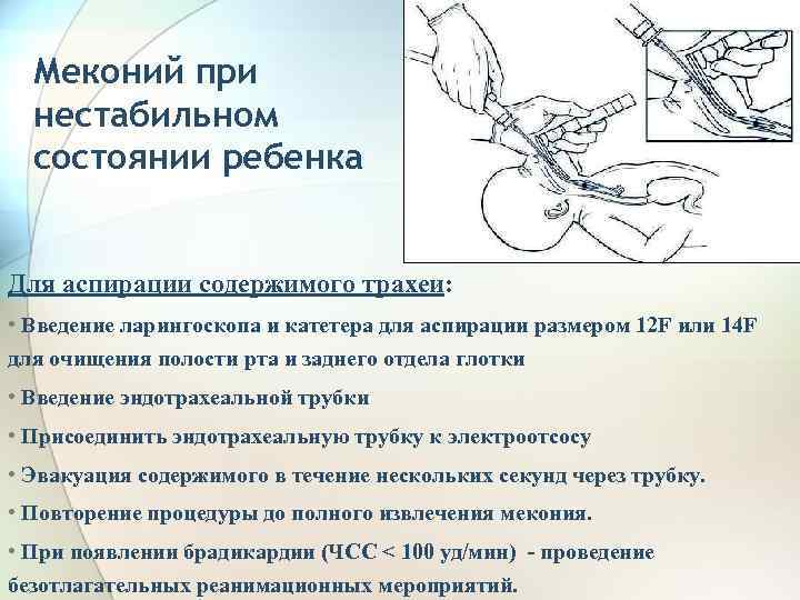 Аспирация меконием у новорожденных