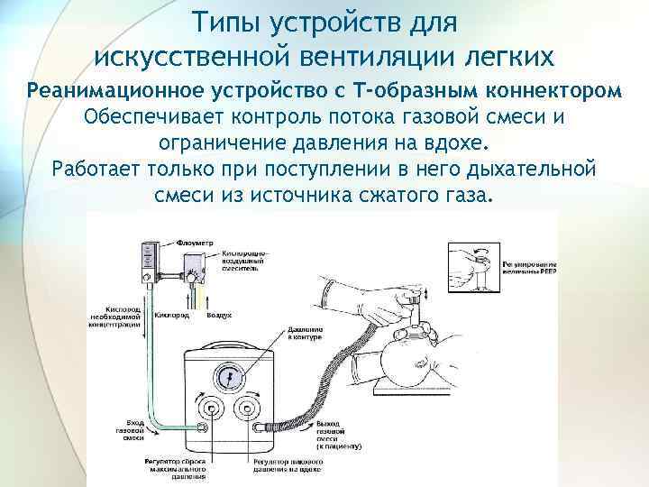 Структурная схема аппарата ивл