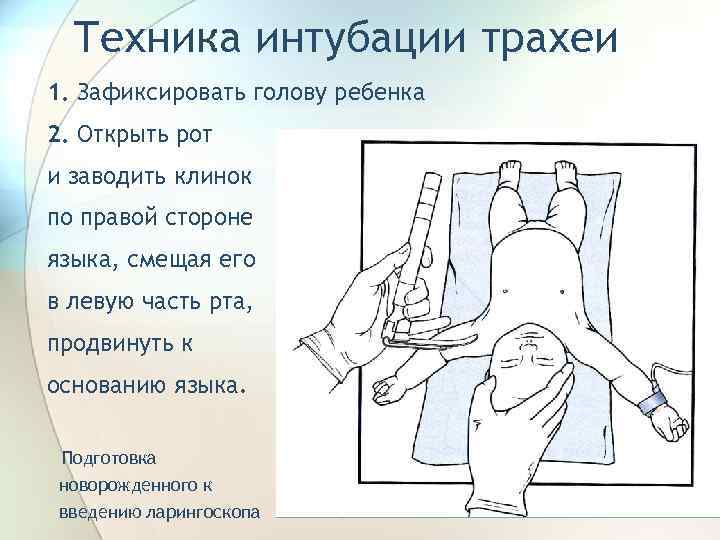 Техника интубации трахеи 1. Зафиксировать голову ребенка 2. Открыть рот и заводить клинок по