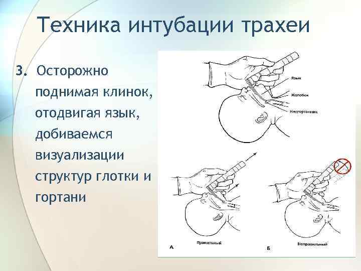 Интубация трахеи