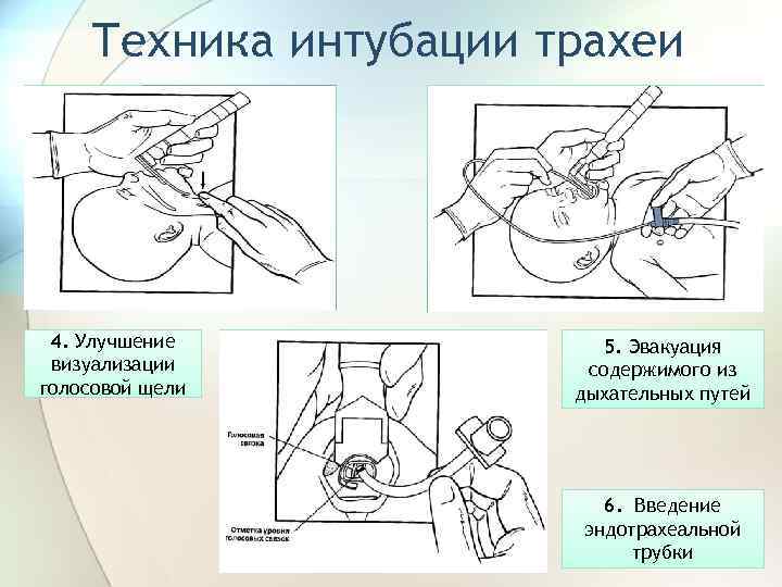 Техника интубации трахеи 4. Улучшение визуализации голосовой щели 5. Эвакуация содержимого из дыхательных путей