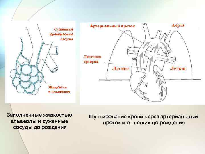 Суженные кровеносные сосуды Артериальный проток Аорта Легочная артерия Легкое Жидкость в альвеолах Заполненные жидкостью