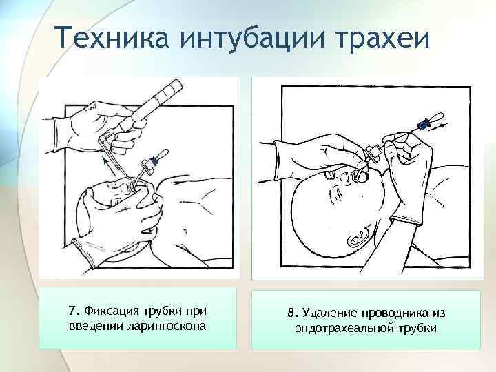 Интубация трахеи картинки