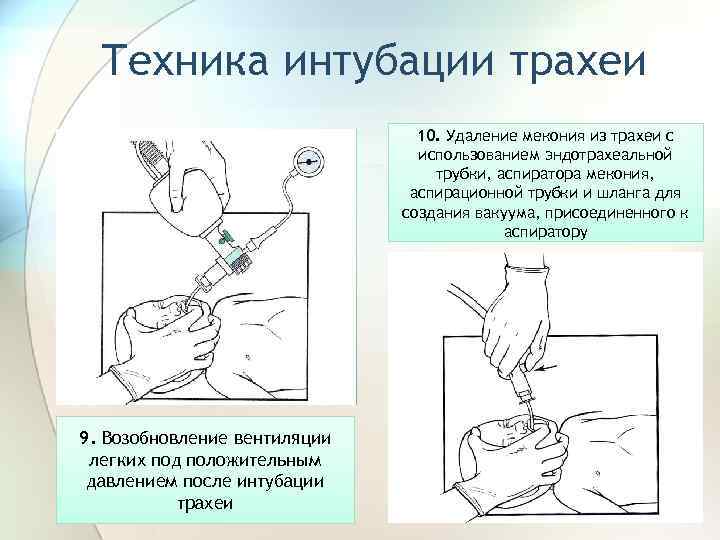 Техника интубации трахеи 10. Удаление мекония из трахеи с использованием эндотрахеальной трубки, аспиратора мекония,