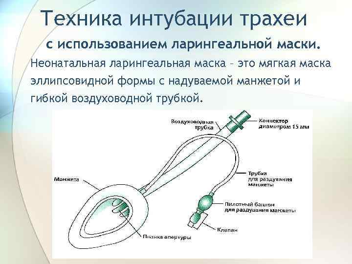 Техника интубации трахеи с использованием ларингеальной маски. Неонатальная ларингеальная маска – это мягкая маска