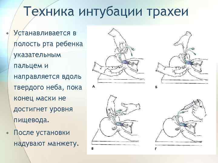 Техника интубации трахеи • Устанавливается в полость рта ребенка указательным пальцем и направляется вдоль