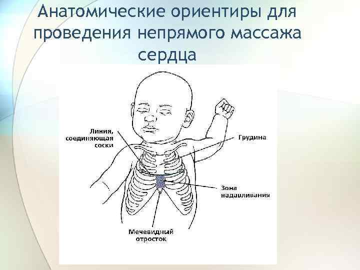 Анатомические ориентиры для проведения непрямого массажа сердца 