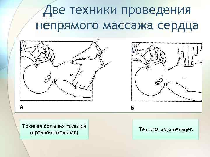 Две техники проведения непрямого массажа сердца Техника больших пальцев (предпочтительная) Техника двух пальцев 