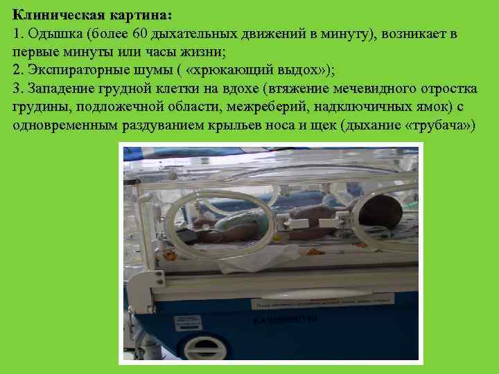 Клиническая картина: 1. Одышка (более 60 дыхательных движений в минуту), возникает в первые минуты