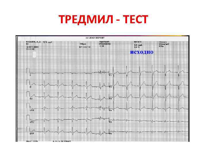 ТРЕДМИЛ - ТЕСТ 