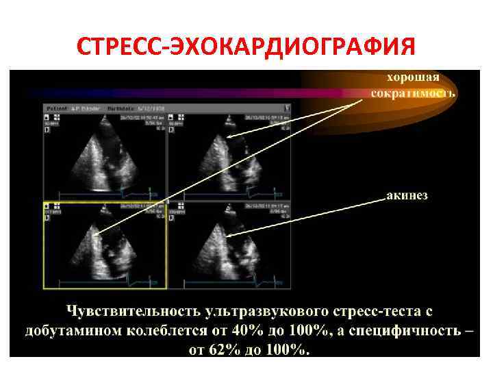 Стресс эхокг презентация