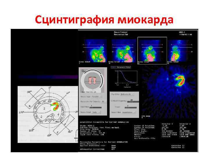 Сцинтиграфия миокарда. Двухэтапная сцинтиграфия миокарда. Сцинтиграфия принцип метода. Перфузионная сцинтиграфия таллием. Сцинтиграфия сердца с нагрузкой.