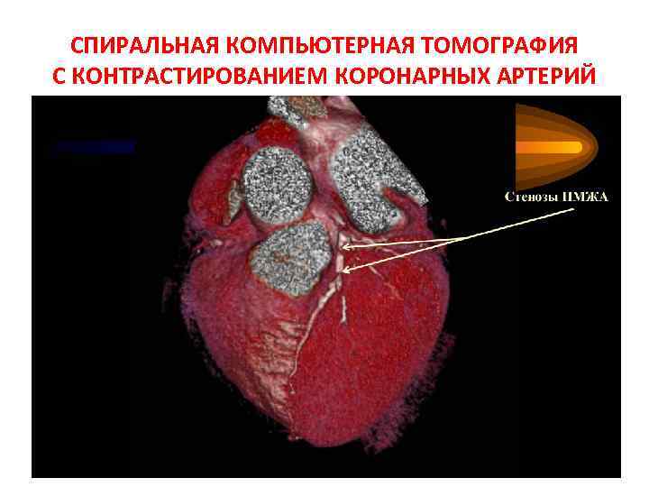 СПИРАЛЬНАЯ КОМПЬЮТЕРНАЯ ТОМОГРАФИЯ С КОНТРАСТИРОВАНИЕМ КОРОНАРНЫХ АРТЕРИЙ 