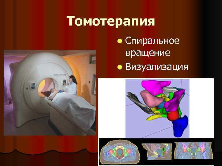 Томотерапия l Спиральное вращение l Визуализация 