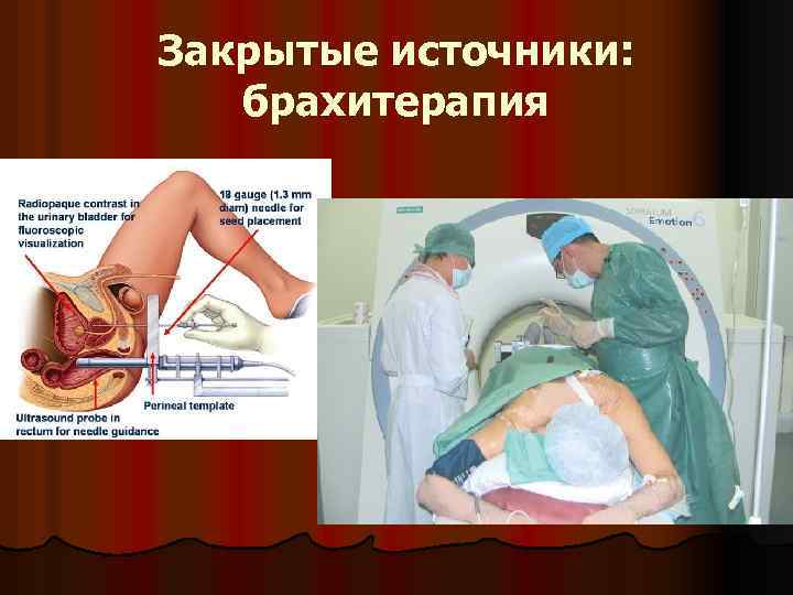 Закрытые источники: брахитерапия 