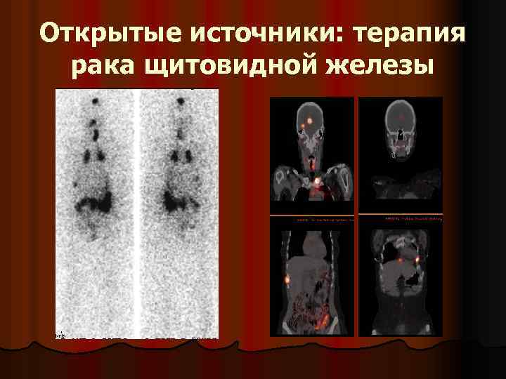 Открытые источники: терапия рака щитовидной железы 