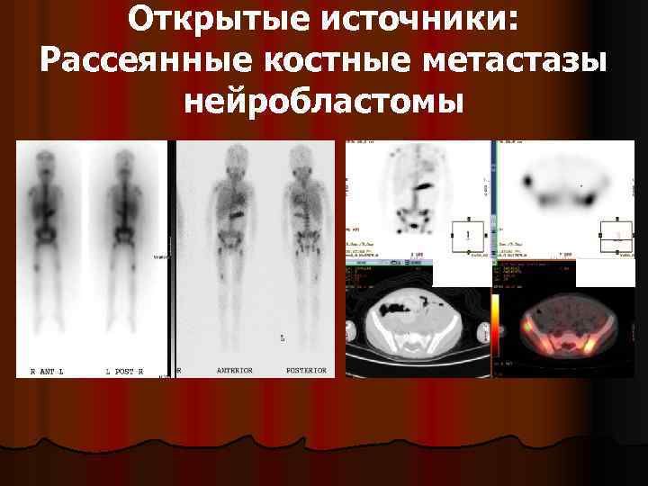 Открытые источники: Рассеянные костные метастазы нейробластомы 